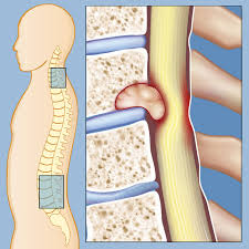 Surgery for Spine Tumors