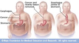 Esophageal Cancer Treatment