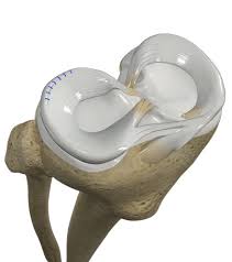 Meniscus Repair Surgery