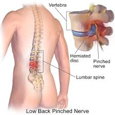 Microdiscectomy