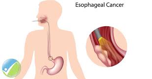 Esophageal Cancer Treatment