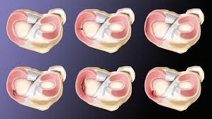 Meniscus Repair Surgery