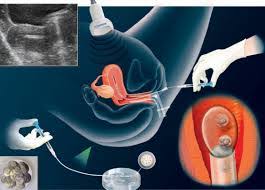 Embryo Cryopreservation/Embryo Freezing