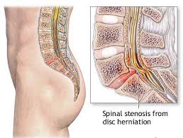 Microdiscectomy