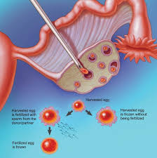 Embryo Cryopreservation/Embryo Freezing