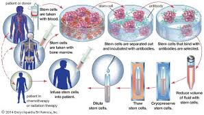 Bone Marrow Transplants Surgery