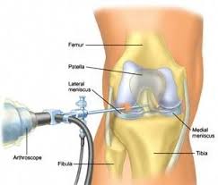 Meniscus Repair Surgery