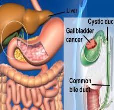 Gallbladder Cancer Treatment | Aafiya International