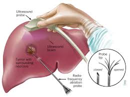 Liver Cancer Treatment