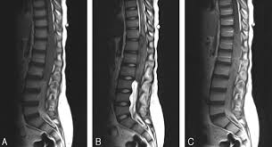 Surgery for Spine Tumors