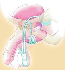 Male Urinary Incontinence