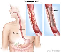 Coronary Heart Bypass Surgery