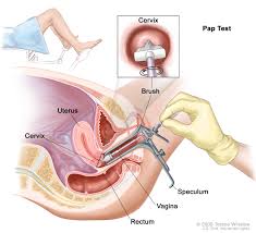 Cervical Cancer Treatment