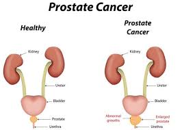 Prostate Cancer Treatment