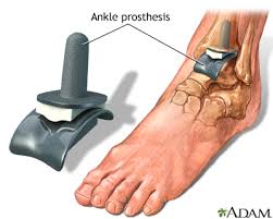 Ankle Replacement Surgery