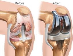 Shoulder Joint Replacement Surgery