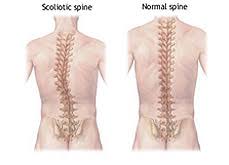 Scoliosis and Kyphosis Surgery