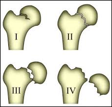 Partial Hip Replacement Surgery