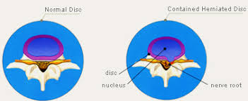 Minimally Invasive Disc Nucleoplasty Surgery