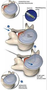 Minimally Invasive Disc Nucleoplasty Surgery