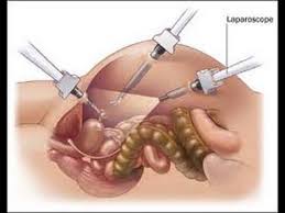 Laparoscopic Ovarian Drilling