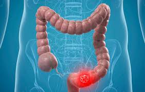 Colon Cancer Treatment