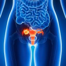 Ovarian Cancer Treatment