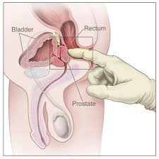 Prostate Cancer Treatment