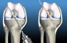 Anterior Cruciate Ligament