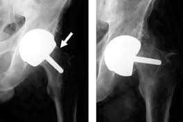 Hip Resurfacing Surgery