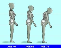 Vertebroplasty