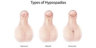 Male Hypospadias