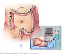 Colon Cancer Treatment