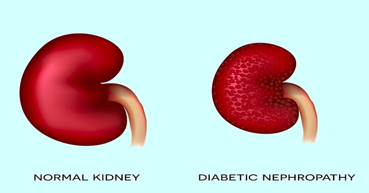 Diabetic Kidney Disorder