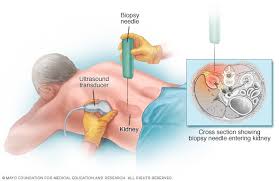 Diabetic Kidney Disorder