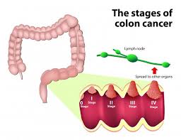 Colon Cancer Treatment