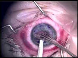 Corneal Transplant Surgery