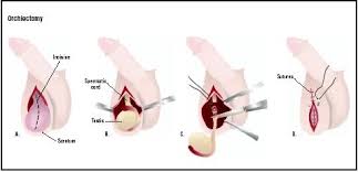 Orchiectomy