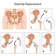 Hip Resurfacing Surgery