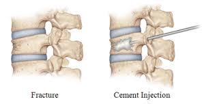 Vertebroplasty