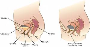 Female Urinary Incontinence