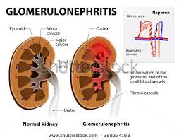 Glomerulonephritis