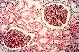 Glomerulonephritis