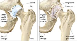 Hip Resurfacing Surgery