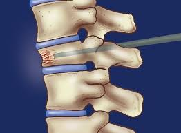 Vertebroplasty