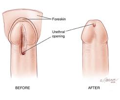 Male Hypospadias