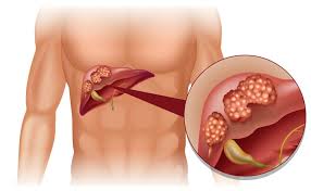 Liver Cancer Treatment