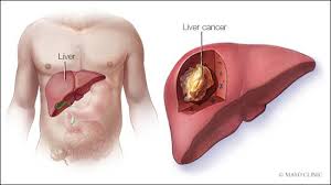 Liver Cancer Treatment