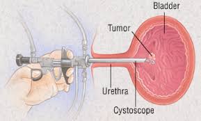 Urinary Bladder Cancer Treatment